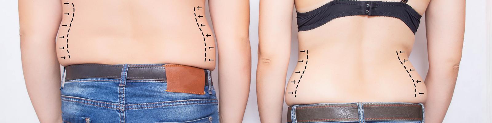 smartlipo