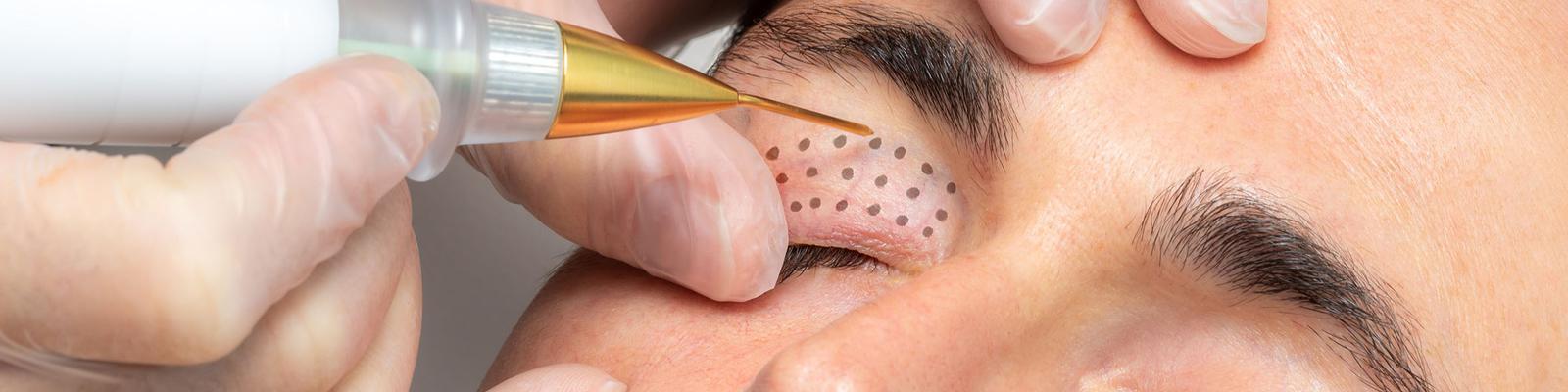 plasma-skin-rejuvenation