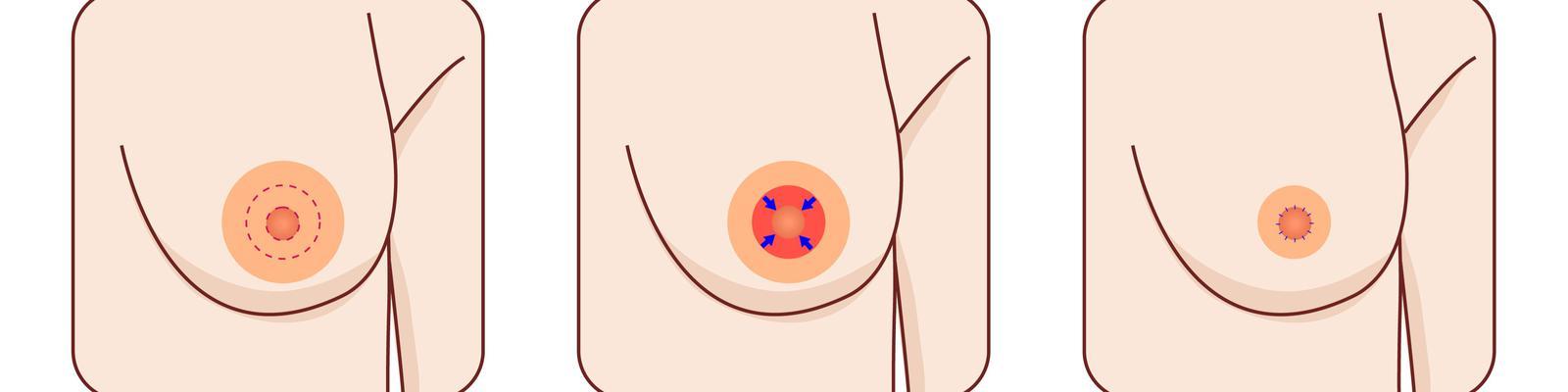 areola-reduction