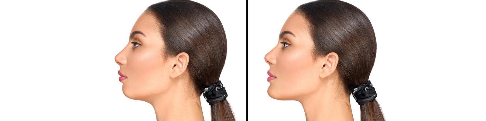 chin-implant