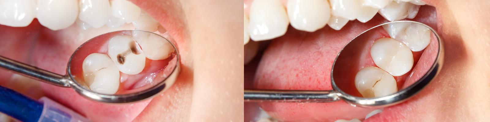 teeth-fillings