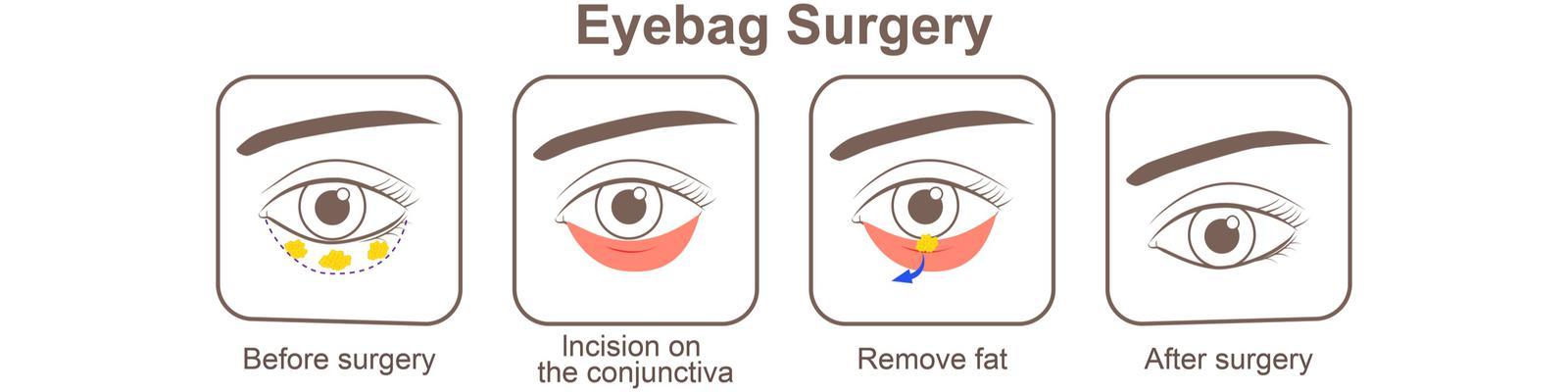 eye-bags-removal