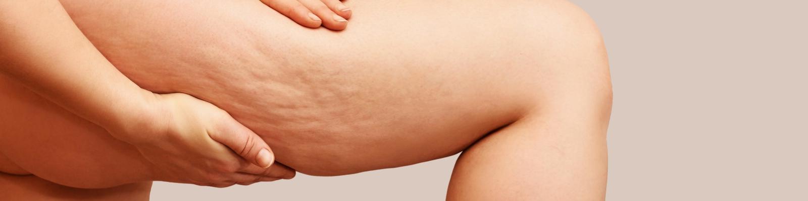 non-invasive-cellulite-therapy