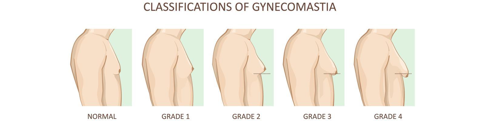 gynaecomastia-surgery