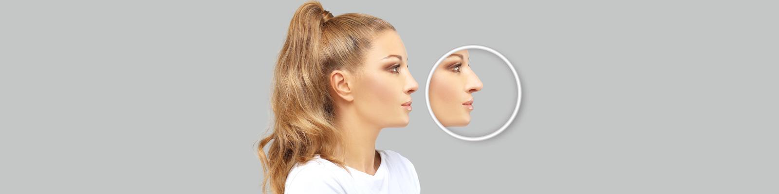 rhinoplasty