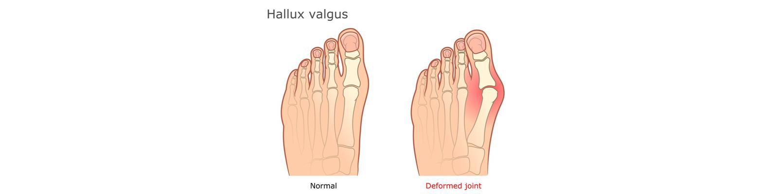 hallux-valgus