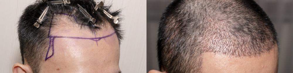 hair-transplantation-fue