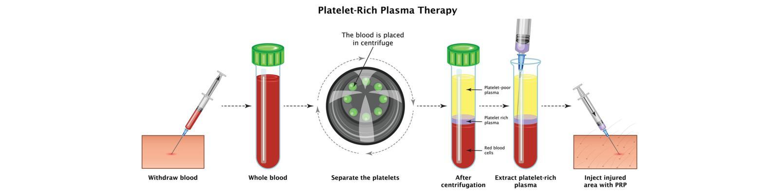 platelet-rich-plasma