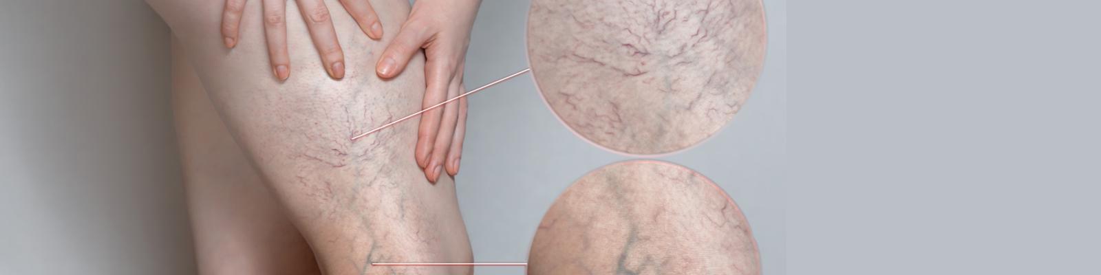 sclerotherapy