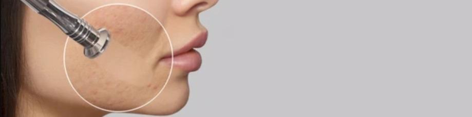 microdermabrasion