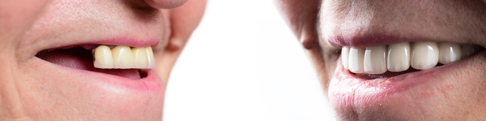 dental-implants