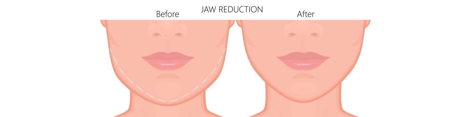 jaw-reduction