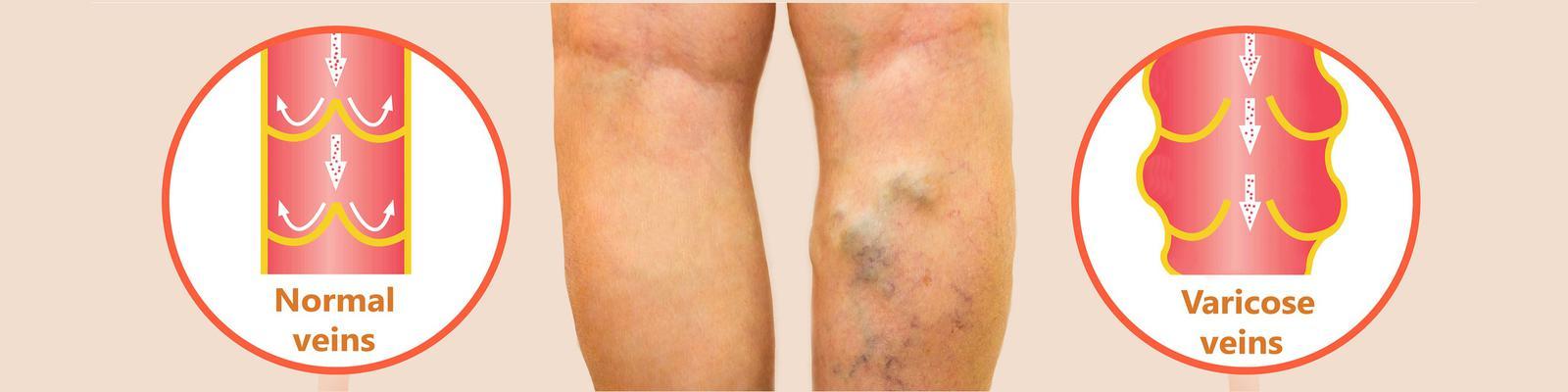 varicose-veins