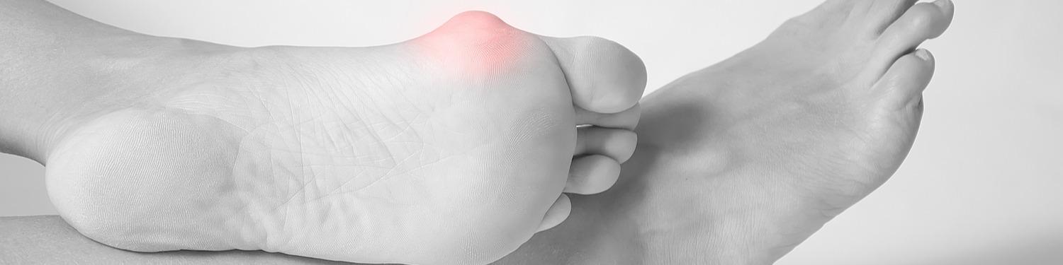bunion-surgery