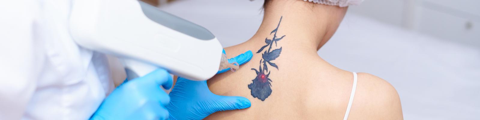 laser-tattoo-removal