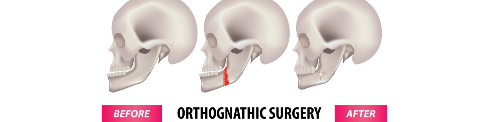 orthognathic-surgery-for-maxilla-and-jaw