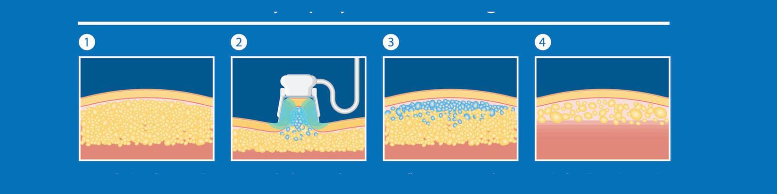 coolsculpting