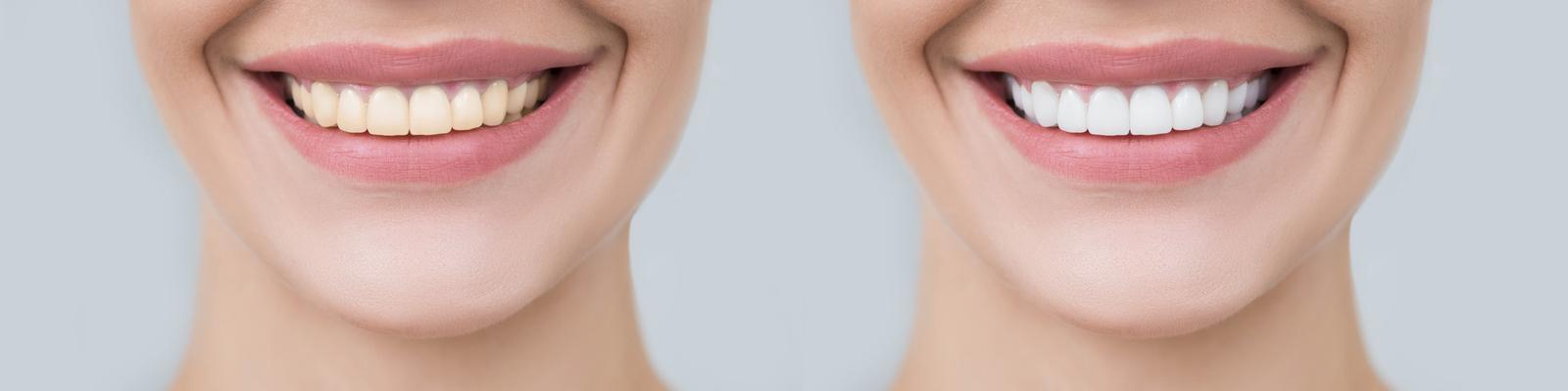 tray-teeth-whitening