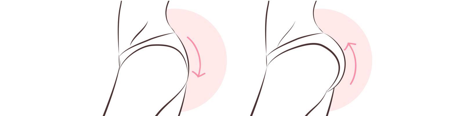 buttock-enhancement