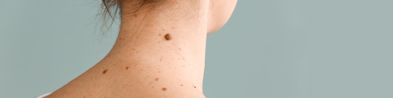 skin-lesions-and-moles