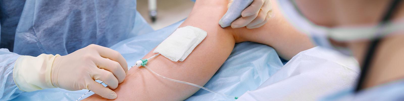 varicose-vein-surgery