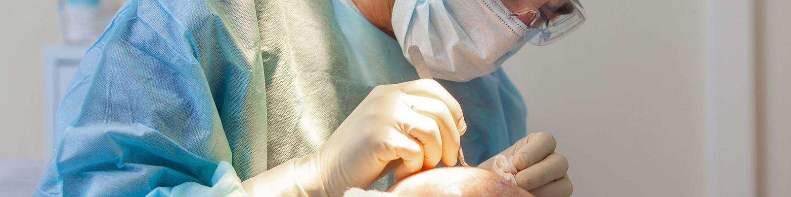 hair-transplantation-fut