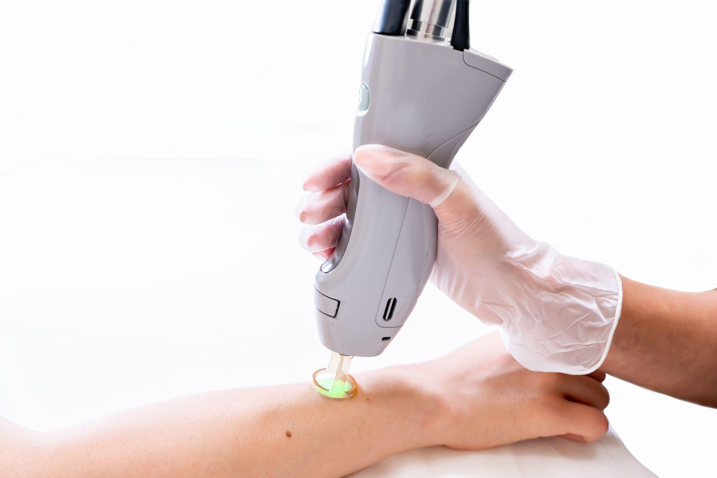 7-laser-hair-removal-myths-busted