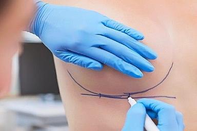 breast-augmentation-with-fat-transfer
