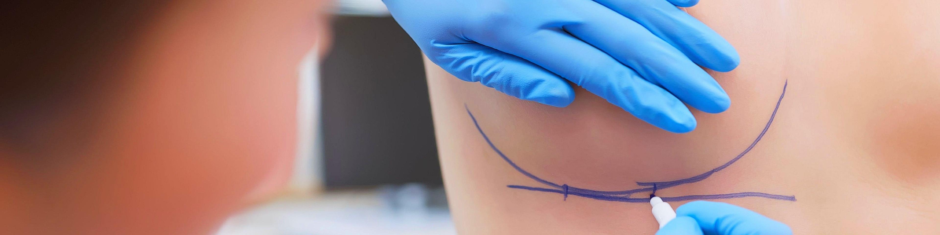 breast-augmentation-with-fat-transfer