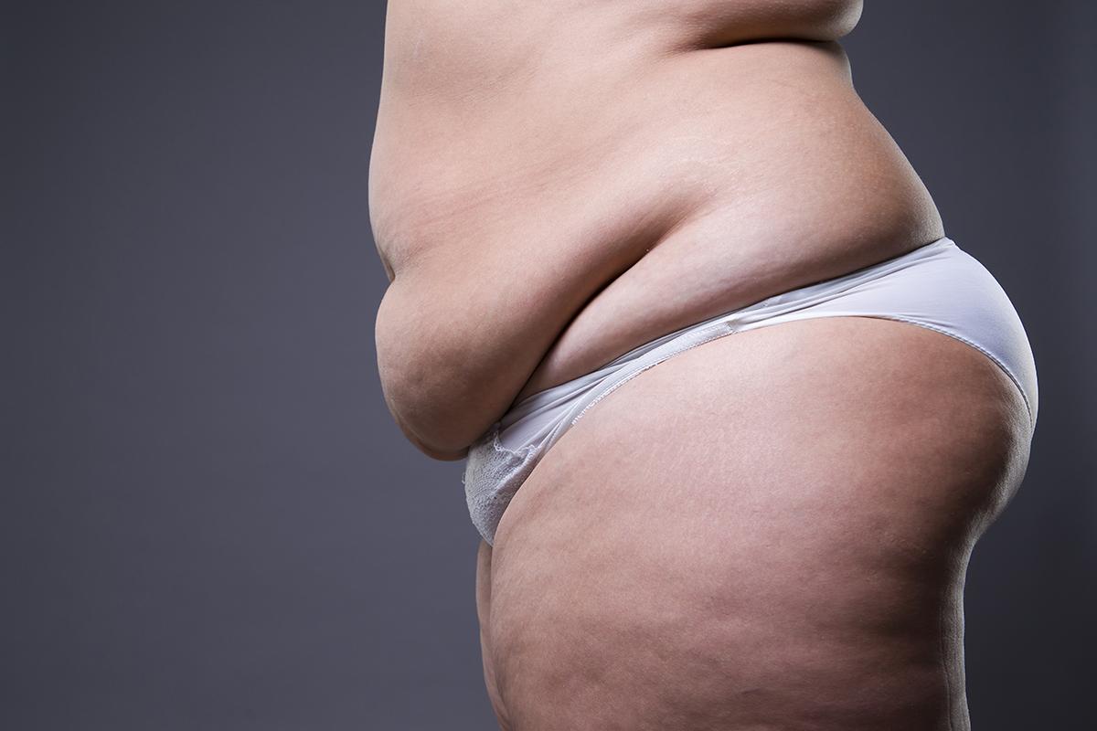 tummy-tuck