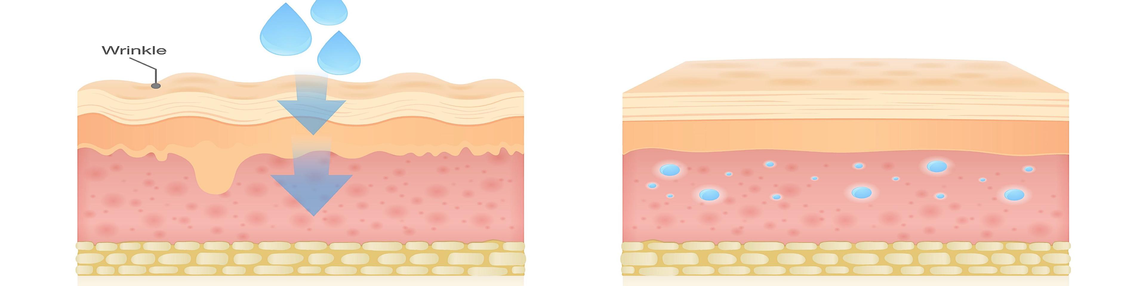 dermal-fillers