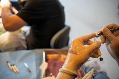 dhi-hair-transplant