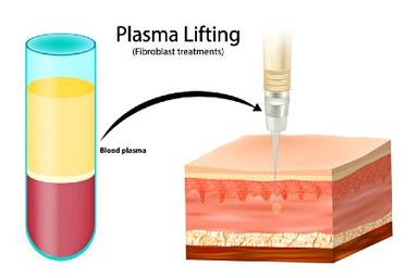 plasma-skin-tightening
