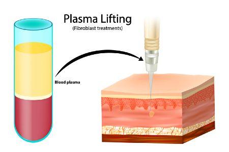 plasma-skin-tightening