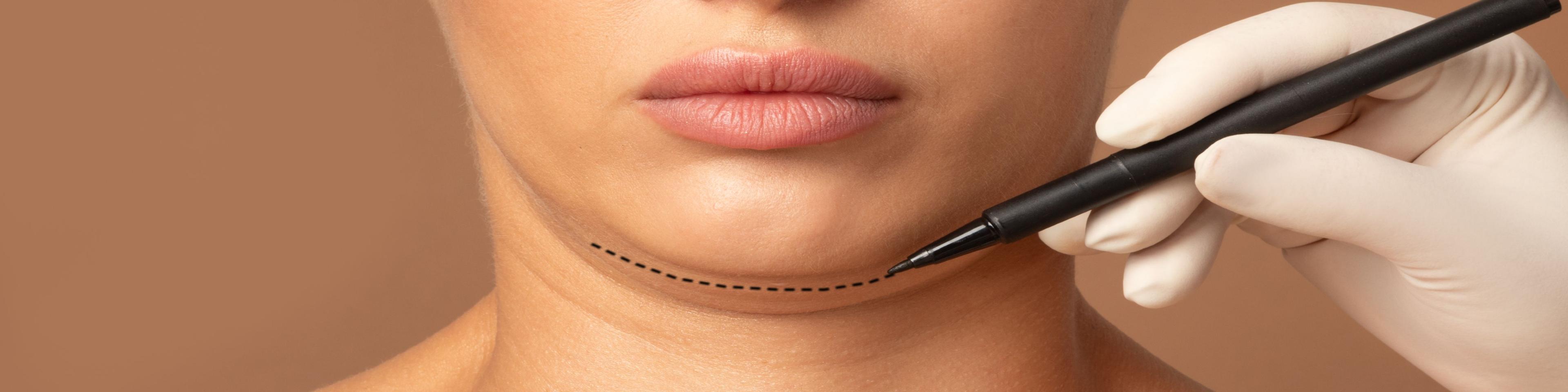 kybella