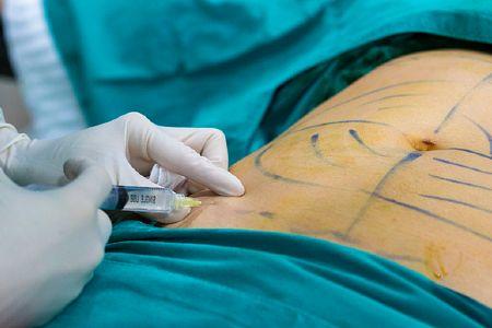 liposculpture