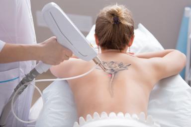 is-it-worth-it-to-invest-in-a-tattoo-removal-laser