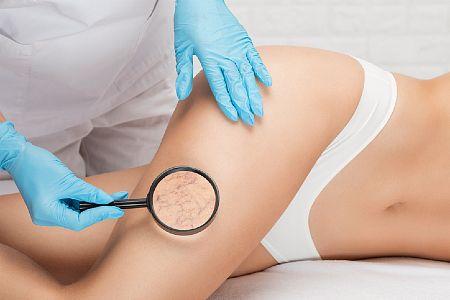 vbeam-laser-treatment